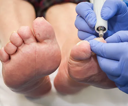 Diabetic Foot Care