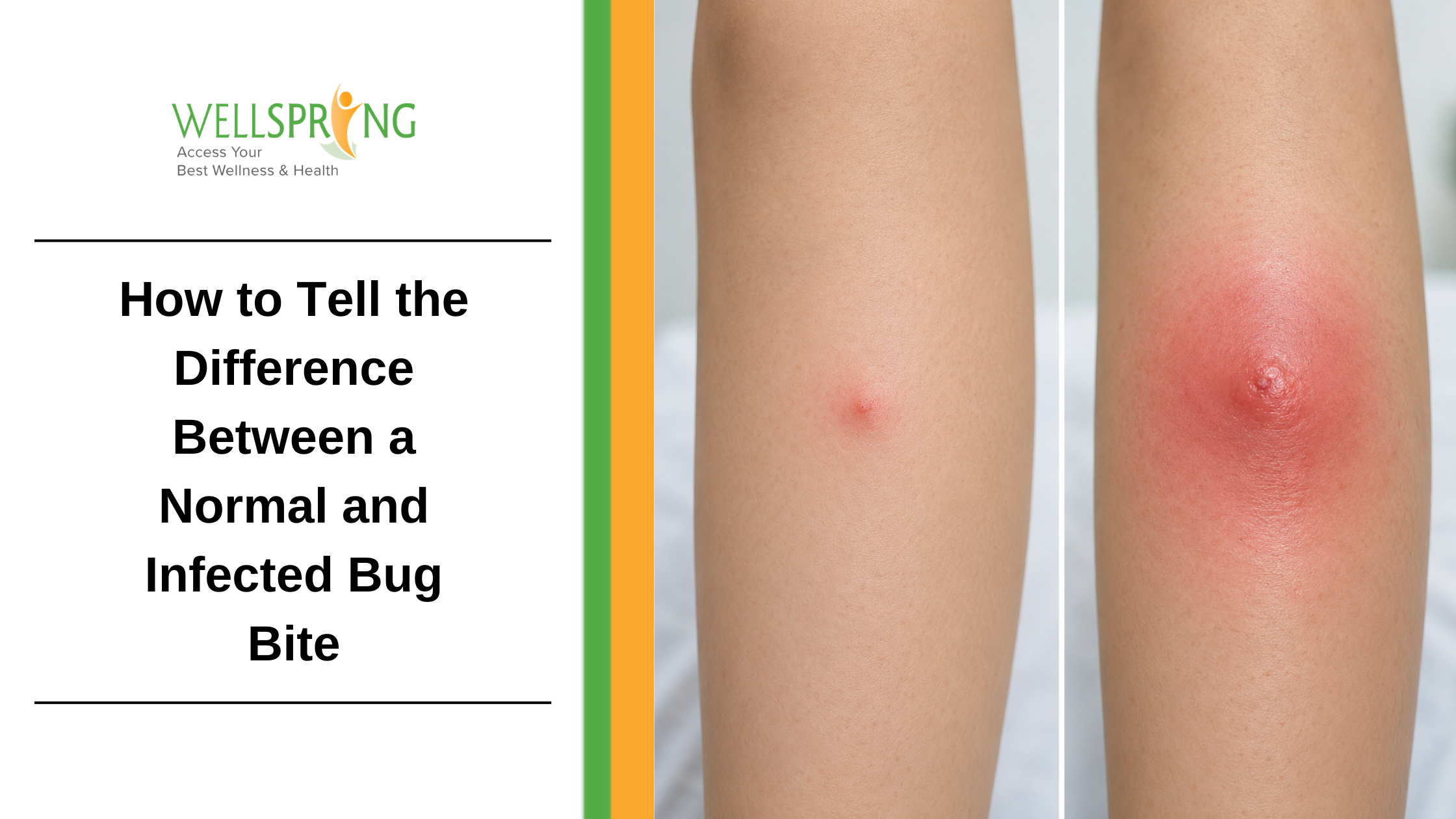 How to Tell the Difference Between a Normal and Infected Bug Bite