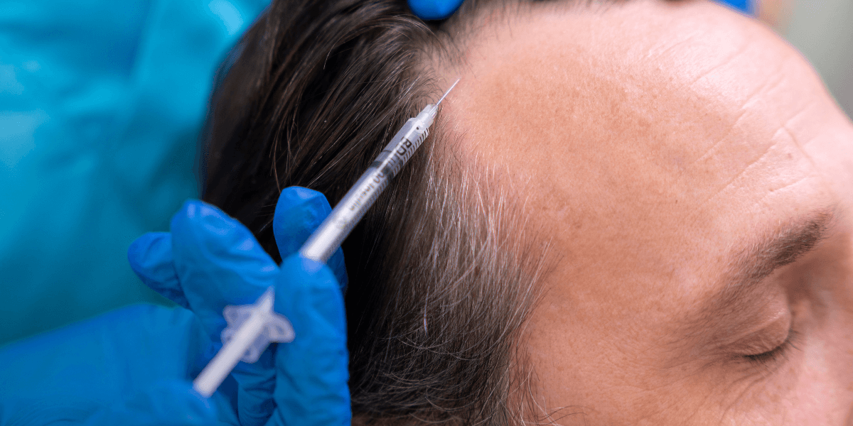What You Should Know About a FUE Hair Transplant