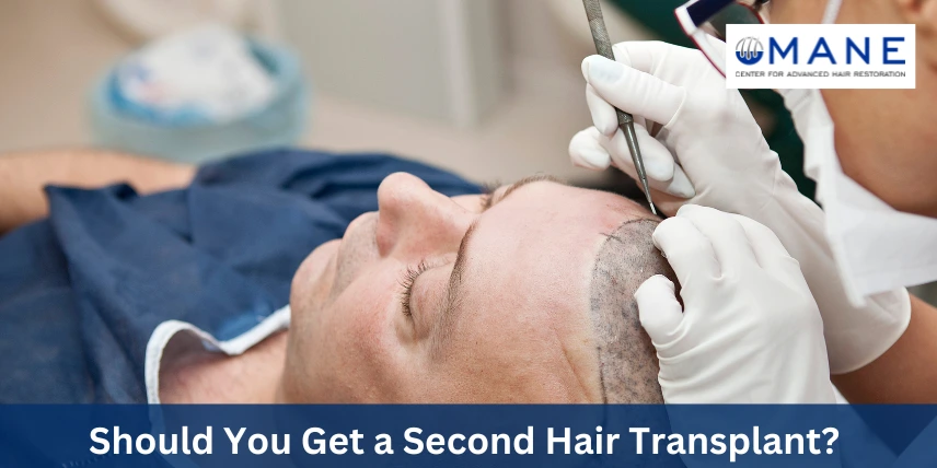 should-you-get-a-second-hair-transplant