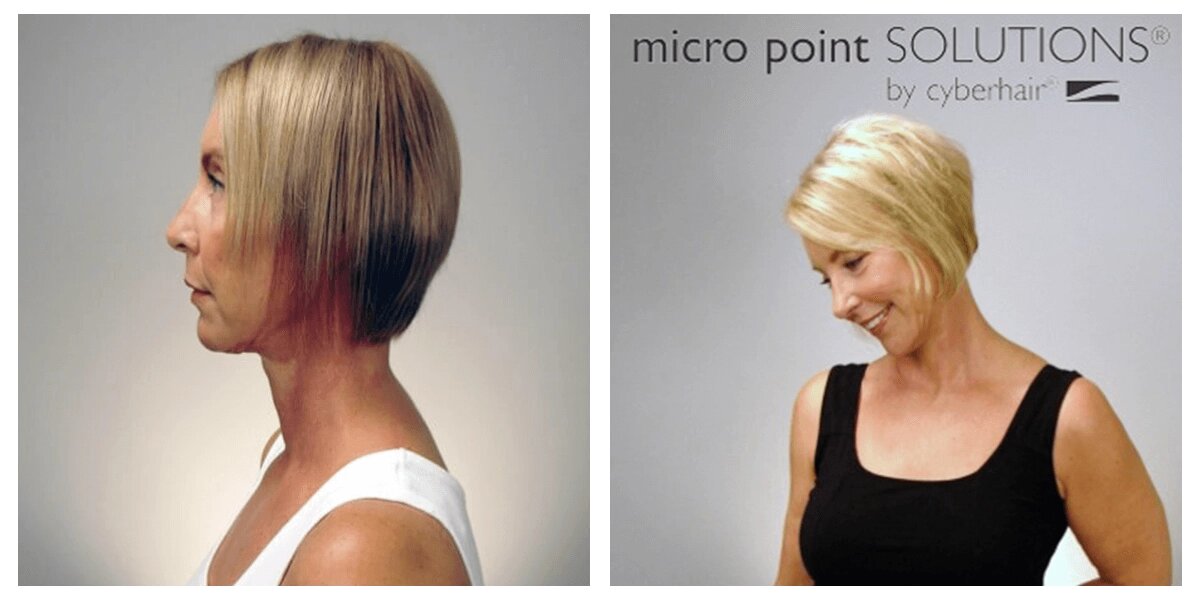 The Ideal Micro Point Procedure Patient