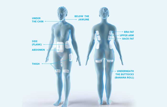 Coolsculpting Can Reduce Fat Almost Anywhere You Need Help