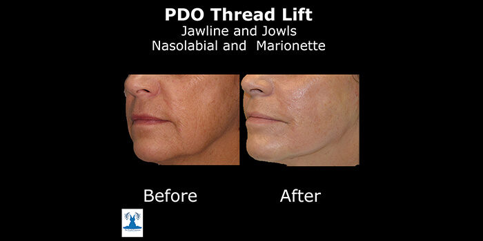 Thread Lift