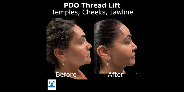 Thread Lift