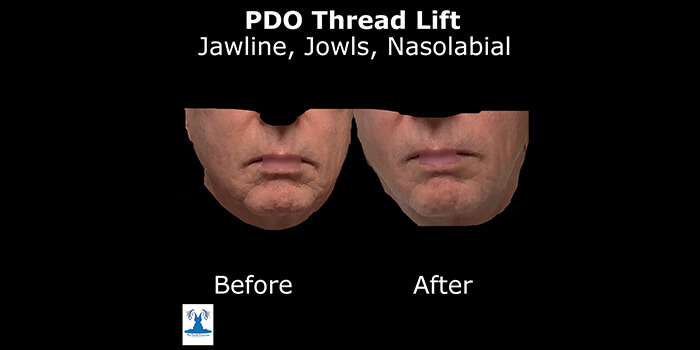 Thread Lift