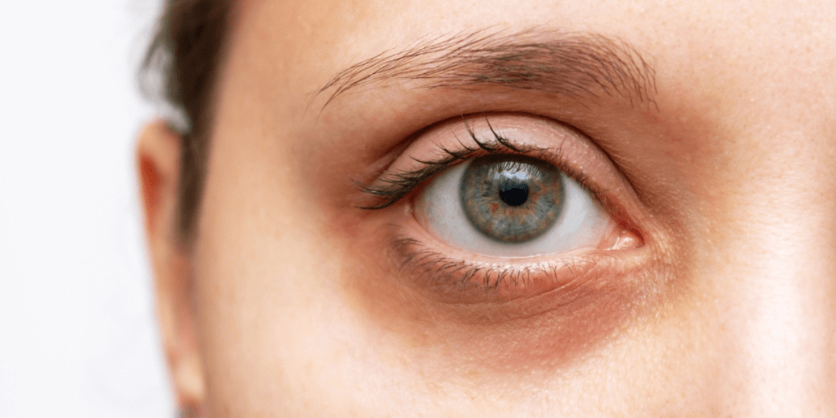 The Ultimate Solution for Tired-Looking Eyes: Under Eye Fillers Explained