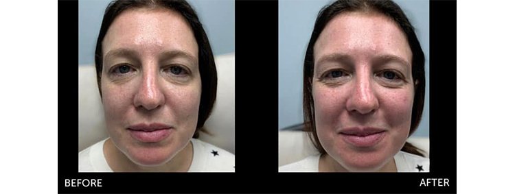 https://cdn.openviowebsites.com/source/sites/fe36e736-8f9e-4953-8b1d-833ad4d3ab9e/images/youth-fountain-before-after-photo-laser-vein-treatment-freehold-nj